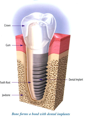 implant_diagram1