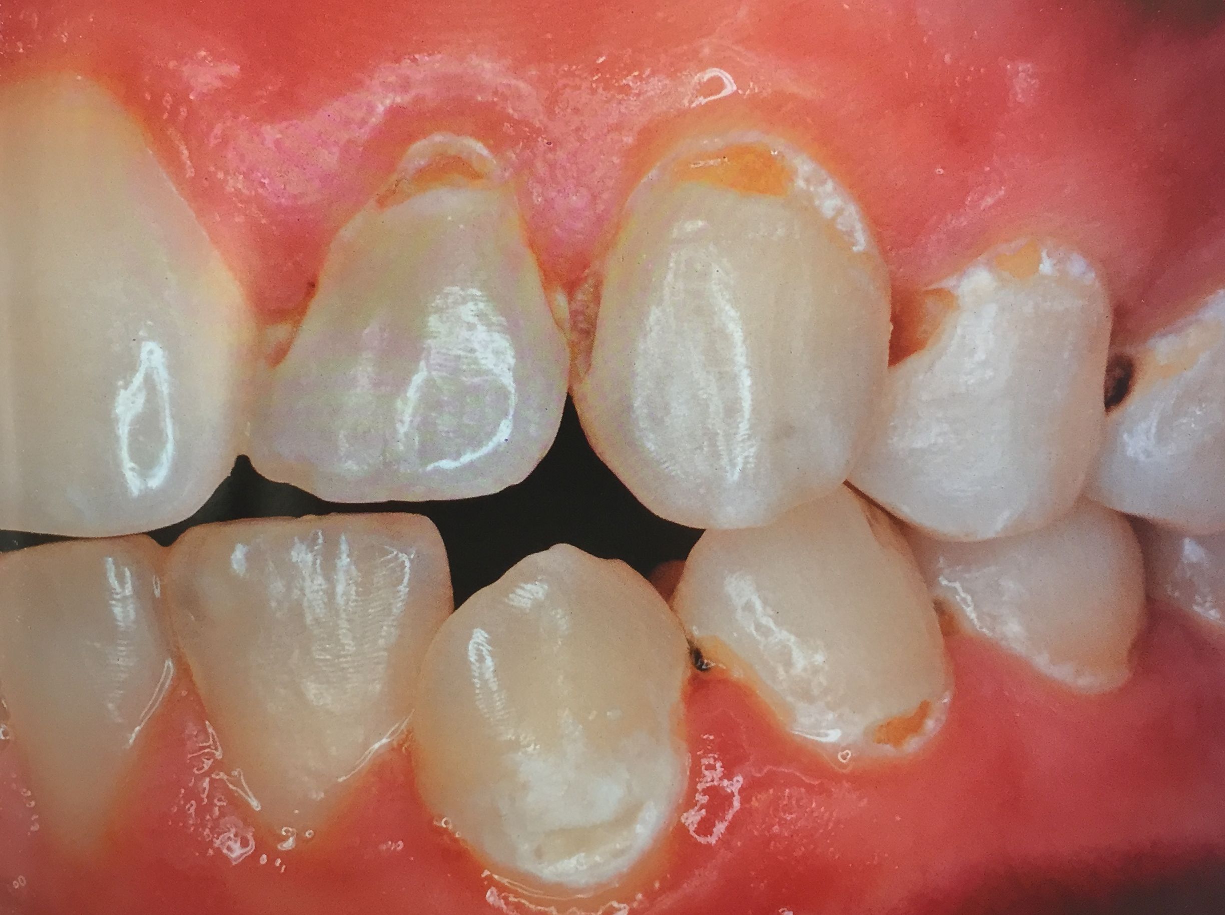 Tooth Plaque - Cheek Dental Blog