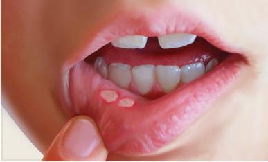 cause of cold sore on tongue