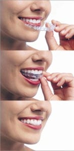 Three vertical nose-to-neck photos of a woman smiling and wearing red lipstick. In photo 1, she is holding aligners near her mouth. In photo 2, she is putting Invisalign aligners on her upper teeth. In photo 3, she is smiling and the aligners are on.