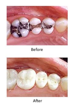 Vertical mercury-free-dentistry before-and-after photos. The upper photo shows three lower teeth with amalgam fillings and the lower photo shows teeth with composite fillings.