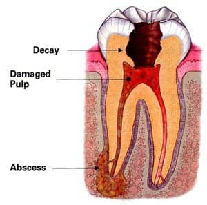 Illustration of abcessed tooth