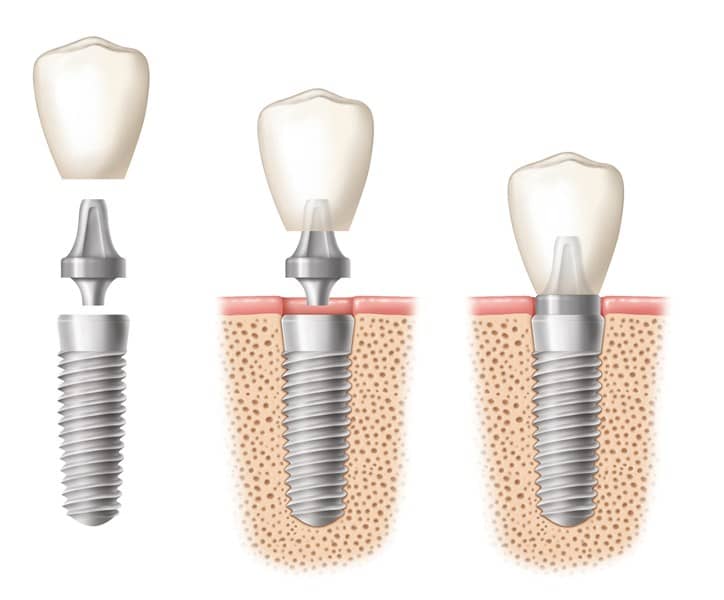 An image of a dental implant crown being placed in three stages