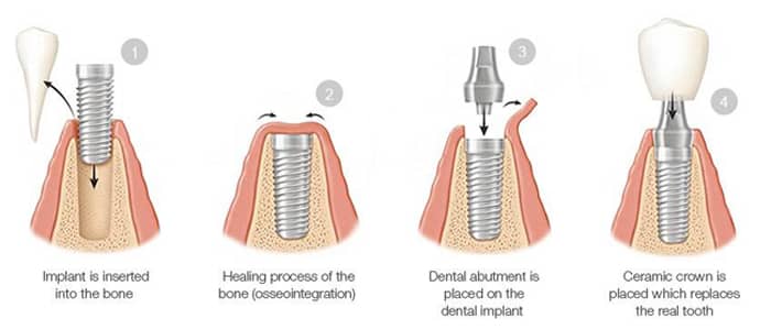 Four-phase diagram of the dental implant process, including insertion in bone, healing process, abutment placement, and ceramic crown attachment; from Cheek Dental in East Cobb, Marietta, GA.