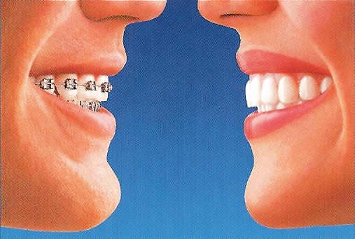 side by side of a smile with braces and a smile with Invisalign