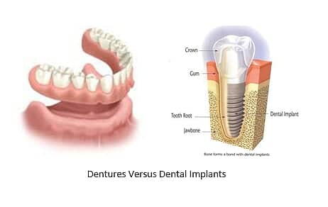 dentures side by side with a dental implant