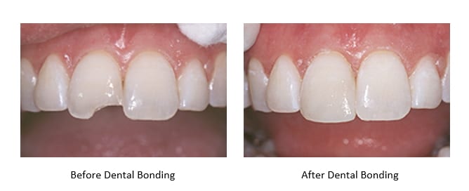 before and after images of dental bonding for chipped teeth