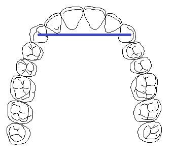 cantivilier bridge diamgram using canines as anchor teeth