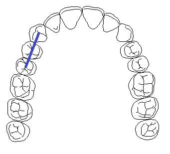 bridge diagram with first premolar as the false tooth