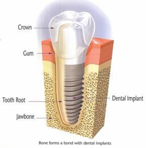 A dental implant diagram