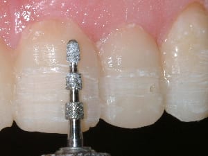 photo of tooth preparation for porcelain veneers