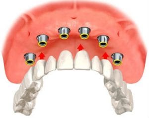 Implant Overdentures