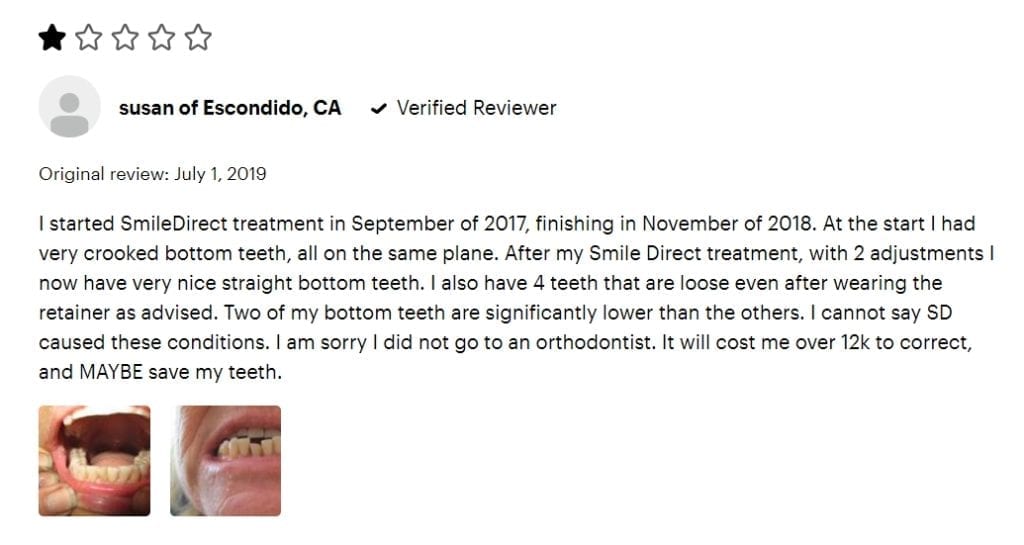 SmileDirectClub review about teeth coming loose