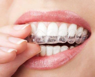 A woman placing teeth whitening trays on her teeth