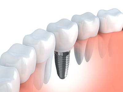 Illustration of a dental implant surrounded by natural teeth