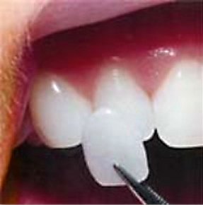 porcelain veneers