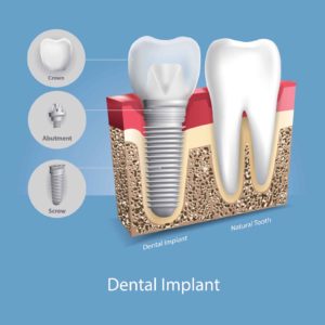 Illustration of a dental implant