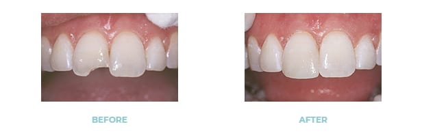 before and after dental bonding