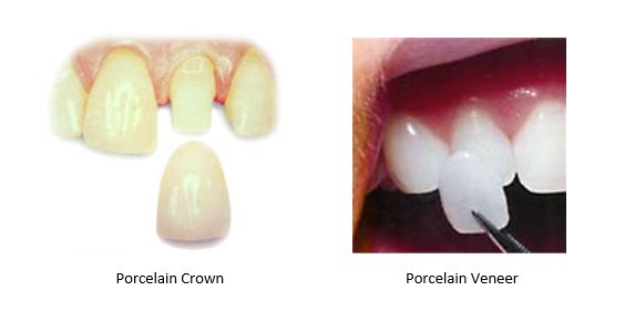 dental crown versus a porcelain veneer