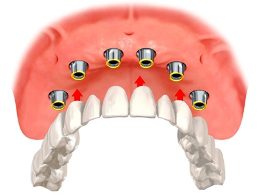 implant supported dentures image