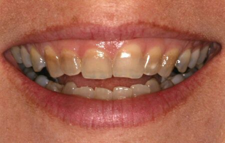 Smile with tetracycline stained teeth.