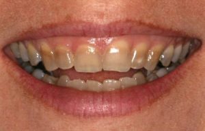 smile with tetracycline stains