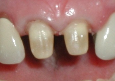 tooth prep for dental crowns