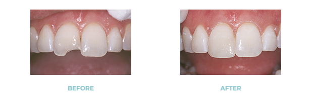 Before and after dental bonding