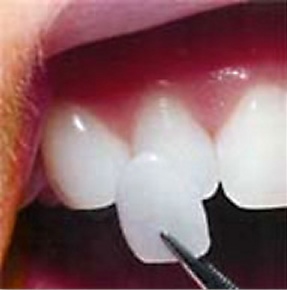 Porcelain Veneer being placed on a front tooth