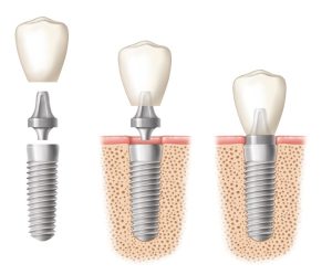 illustration of dental implants being placed.