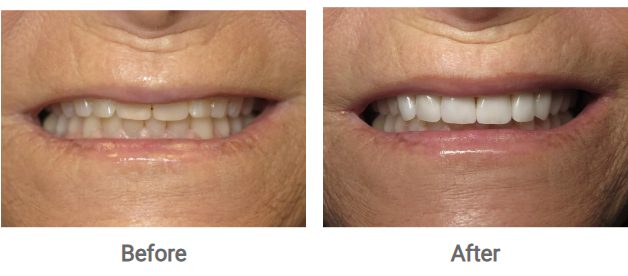 before and after smile makeover