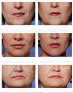 before and after dermal fillers in Marietta