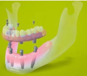 all on four dental implants image