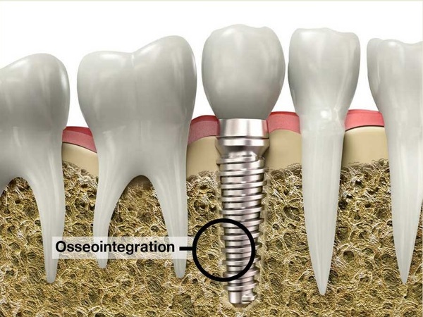 a drawing of five lower teeth, showing the middle tooth replaced with an implant, and an arrow pointing to the osseointegration between the implant and the bone.