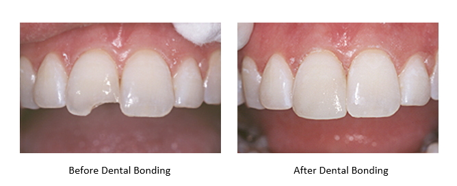 A side by side image of teeth before and after dental bonding