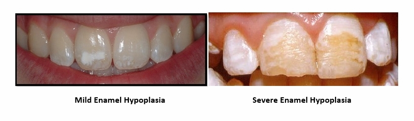 Two examples of enamel hypoplasia